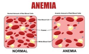 Anemic-Amount-of-Red-Blood-Cell